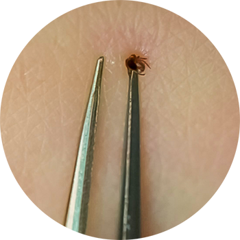 Tick Removal