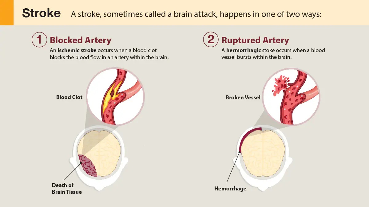 Diagram about how strokes occur
