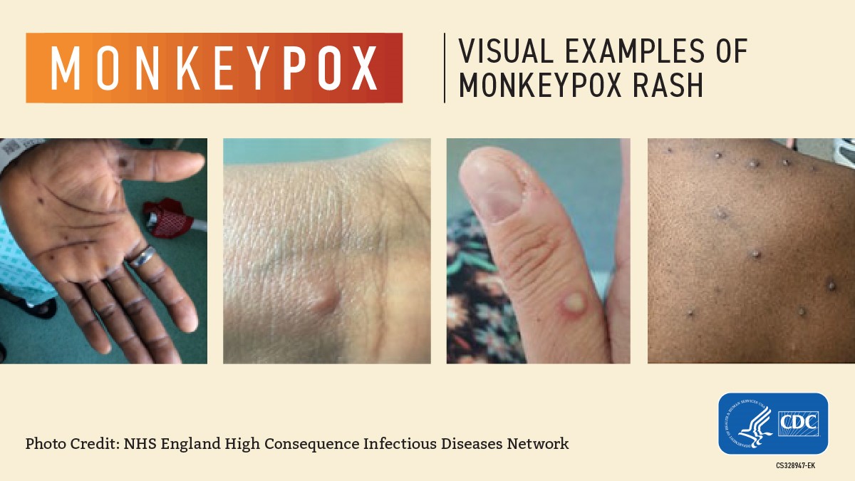 mpox